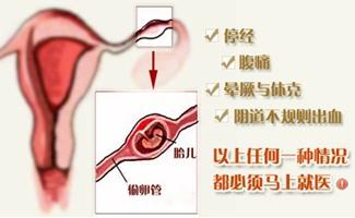 宫外孕症状