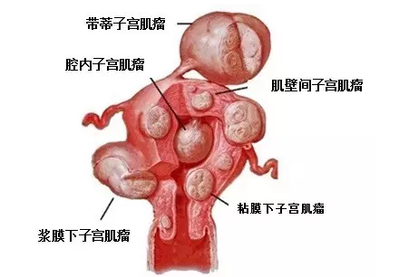子宫肌瘤医学图